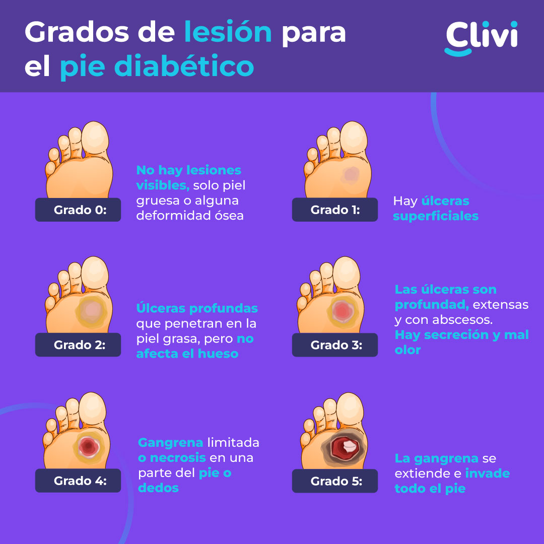 Complicaciones de la diabetes Pie Diabético Clivi