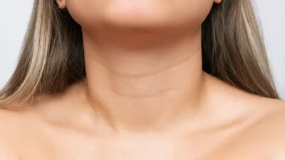 Acantosis Nigricans: Qué es y cómo prevenirla